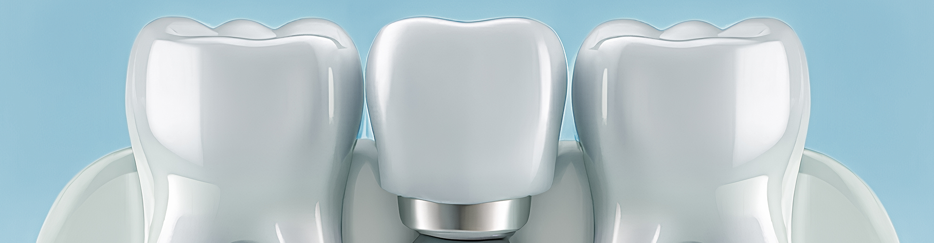 rendering of a dental implant between teeth.